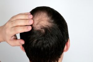 img featured profile hairloss